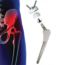 Artroplasti Hip System